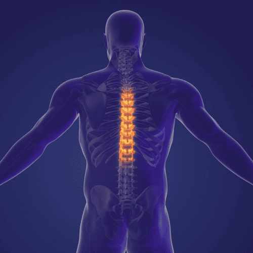 Avoid Long Wait Times for Spinal Fusion Surgery and Discectomy: Choose Mexico